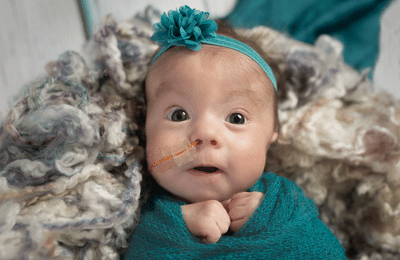 Close up of a baby with feeding tube.